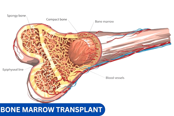 Bone Marrow Transplant