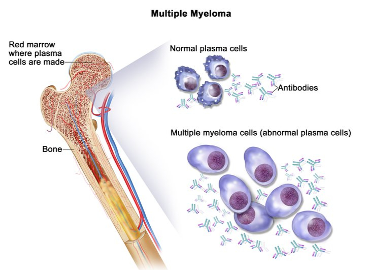 Multiple Myeloma