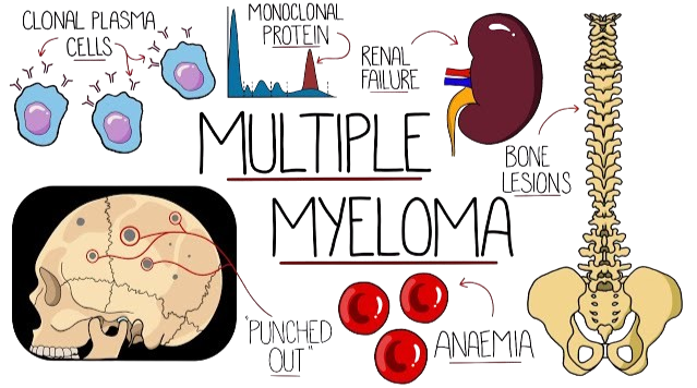 Multiple Myeloma