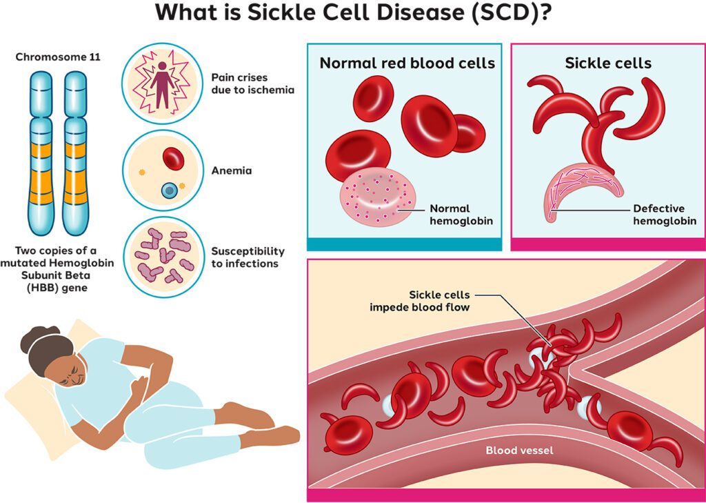 sickle cell anemia