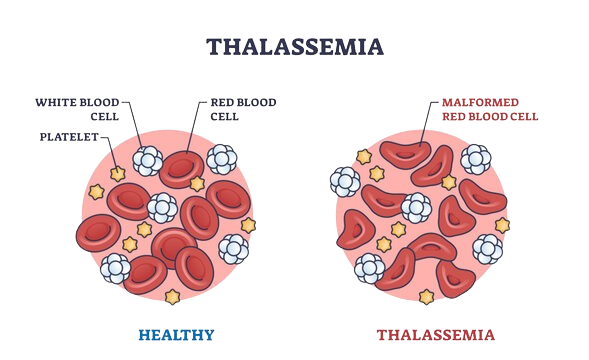 healthy cell and thalassemia cell