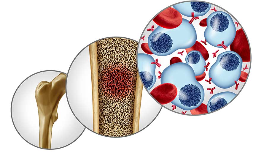 Multiple myeloma bmt next best bone marrow transplant center in gurgaon