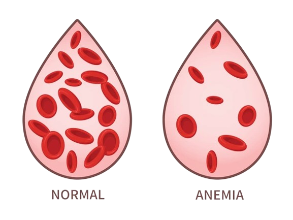 aplastic anemia