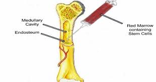 best bone marrow transplant in faridabad in gurugram delhi ncrbmt next