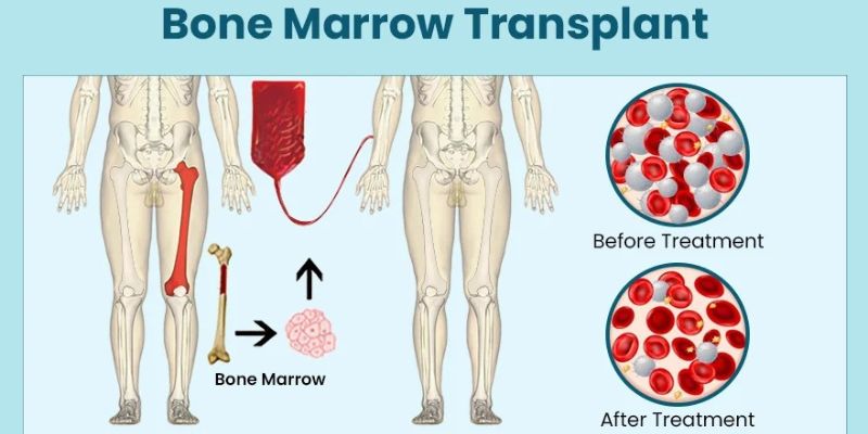 Bone Marrow Transplant BMT Next BMT PROCESS MARENGO ASIA HOSPITALS