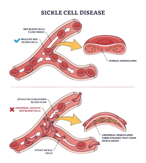 best sickle cell anemia treatment in gurugram gurgaon best bone marrow transplant hospital best bmt treatment bmt next marengo asia hospital
